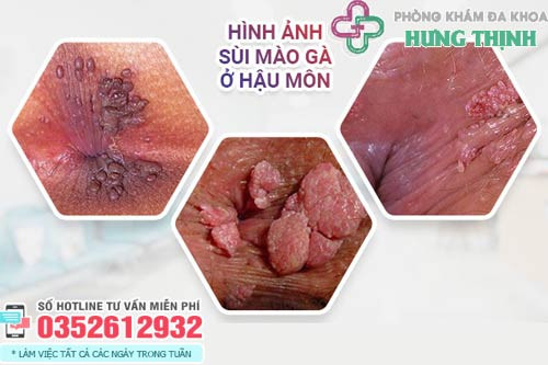 Hình ảnh sùi mào gà ở hậu môn, các nốt sùi không đau có thể nhầm lẫn với thịt thừa