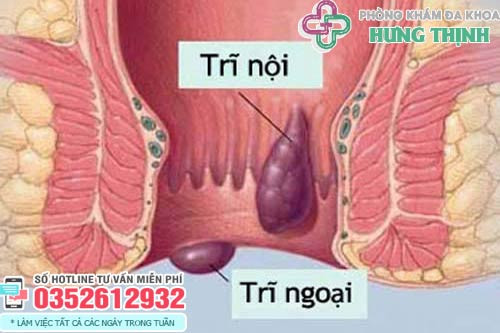 Cục thịt ở hậu môn do búi trĩ sa ra ngoài, gây khó chịu và chảy máu