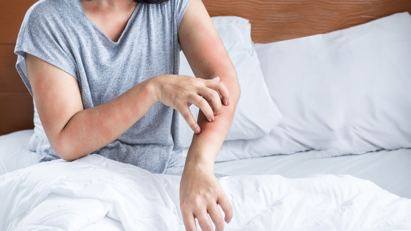 Da nổi mẩn đỏ và phát ban ngứa điển hình khi bị nhiễm sán chó
