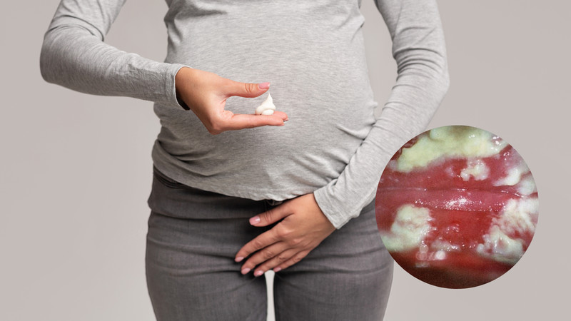 Ngứa vùng kín do nấm men là tình trạng viêm nhiễm phổ biến ở phụ nữ