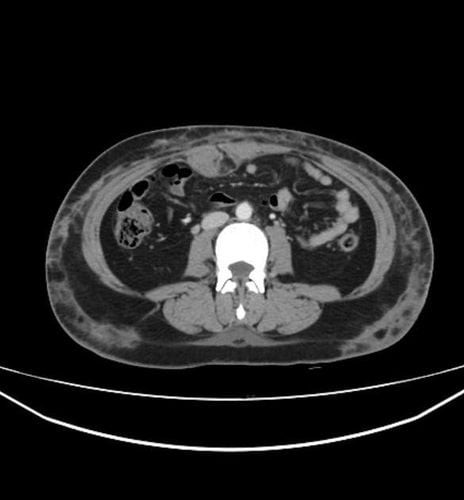Hình ảnh CT scan của trường hợp viêm mô tế bào thành bụng với sưng và đau