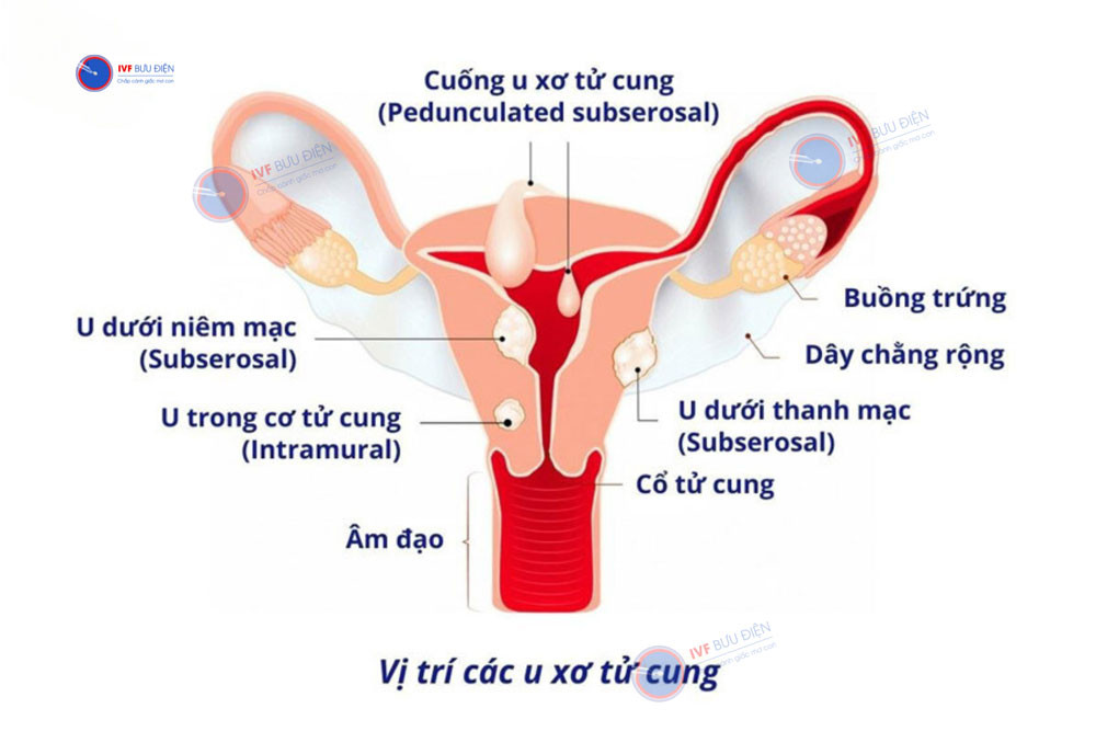 Minh họa cấu trúc tử cung với các vị trí thường gặp của u xơ