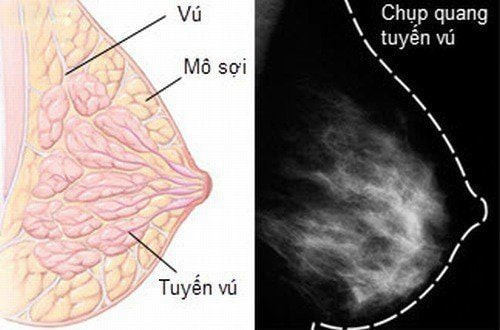 Chụp X-quang tuyến vú để chẩn đoán ung thư