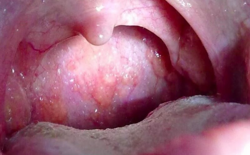 Hình ảnh viêm họng hạt, một dạng u lành tính thường gặp ở vòm họng