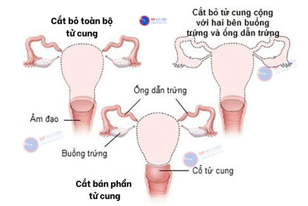 Biểu đồ so sánh các phương pháp phẫu thuật u xơ tử cung phổ biến