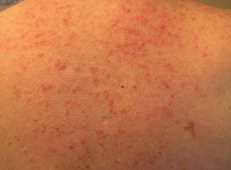 Viêm nang lông nông là một trong những nguyên nhân gây viêm da mủ