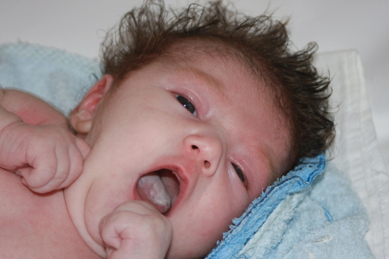 Hình ảnh nấm lưỡi điển hình do Candida Albicans gây nên ở trẻ sơ sinh