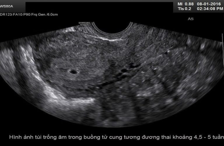 Minh họa siêu âm cho thấy chưa có hình ảnh thai nhi ở tuần đầu tiên