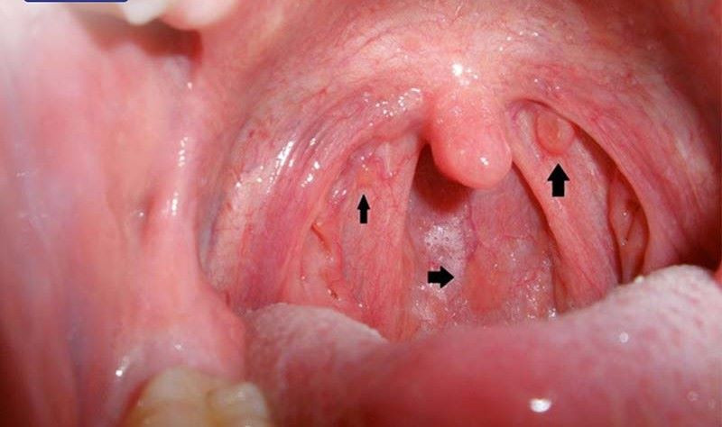 Hình ảnh khối u ung thư vòm họng giai đoạn 1 khó nhận biết bằng mắt thường