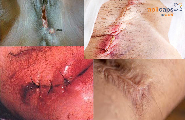 Hình ảnh vết khâu tầng sinh môn qua các giai đoạn