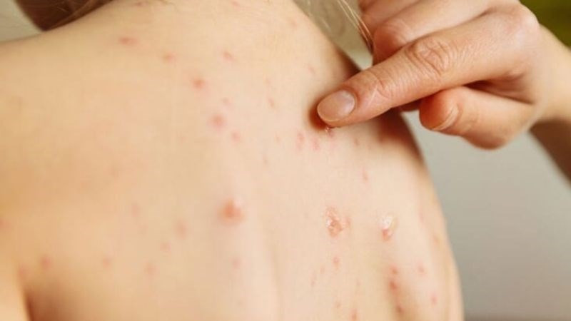 Làn da trẻ em sau khi ban sởi đã lặn, để lại các vết thâm mờ dần