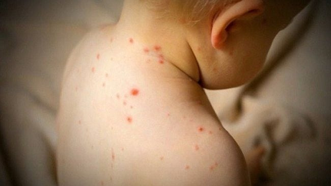 Ban sởi điển hình ở trẻ em trong giai đoạn toàn phát, lan rộng trên cơ thể