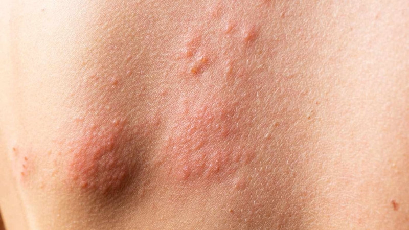 Hình ảnh phát ban trên da HIV là tình trạng da xuất hiện các nốt đỏ, hồng hoặc tím, có thể gây ngứa, rát hoặc đau nhẹ