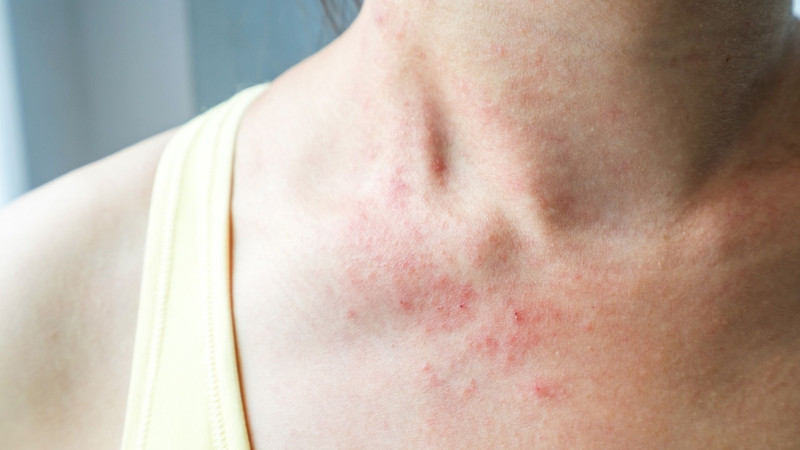 Phát ban trên da do nhiễm HIV có những đặc điểm lâm sàng riêng biệt giúp phân biệt với các loại phát ban thông thường