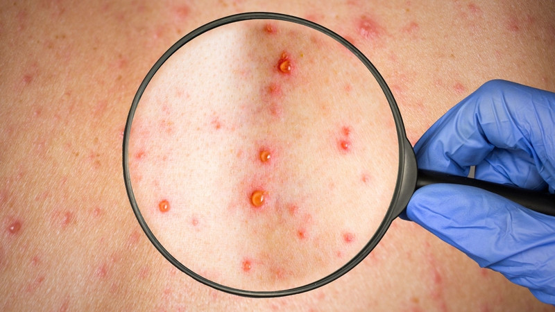 Phát ban HIV kéo dài bao lâu?