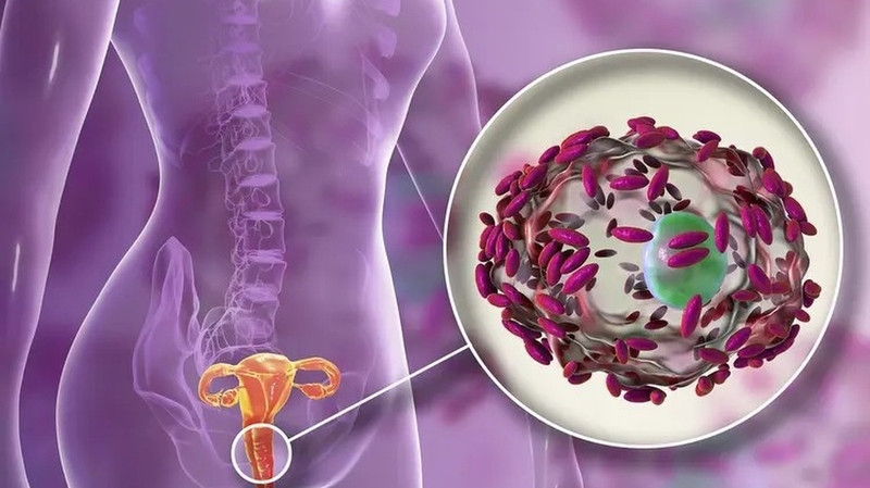 Viêm âm đạo do vi khuẩn thường gây ra khí hư màu bất thường và có mùi tanh khó chịu