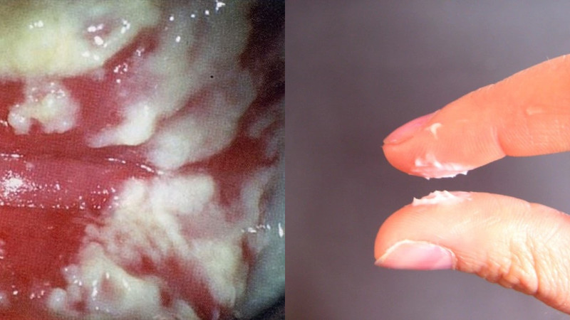 Viêm phụ khoa do nấm Candida đặc trưng bởi khí hư vón cục như bã đậu và ngứa rát vùng kín