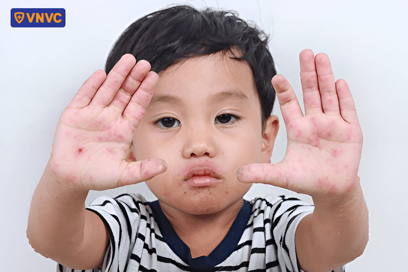 Lòng bàn tay xuất hiện vết loét hoặc nốt ban đỏ