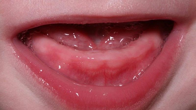 Bé đang ngậm vòng gặm nướu để giảm cảm giác ngứa ngáy, khó chịu khi mọc răng