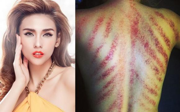 MC Thanh Vân Hugo cũng từng chia sẻ hình ảnh tấm lưng bầm tím chi chít vì cạo gió