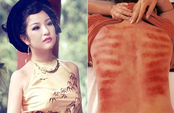 Siêu mẫu Võ Hoàng Yến chia sẻ bức ảnh lưng trần chi chít các vết bầm tím dài vì cạo gió