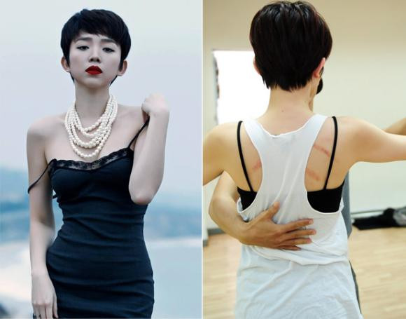 Vết đỏ sau gáy Lê Thúy từng gây ra nhiều tranh cãi về nguyên nhân, trong đó có ý kiến cho rằng đây là vết cạo gió