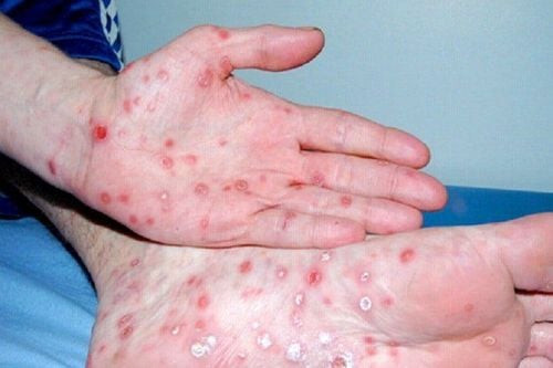 Giang mai có thể truyền nhiễm từ mẹ sang con, cảnh báo nguy cơ nghiêm trọng cho thai nhi
