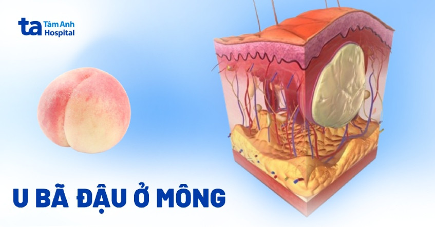 u bã đậu ở mông