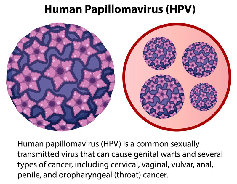 Nhiễm virus HPV là nguyên nhân hàng đầu gây ra u nhú ở lưỡi và nhiều vị trí khác