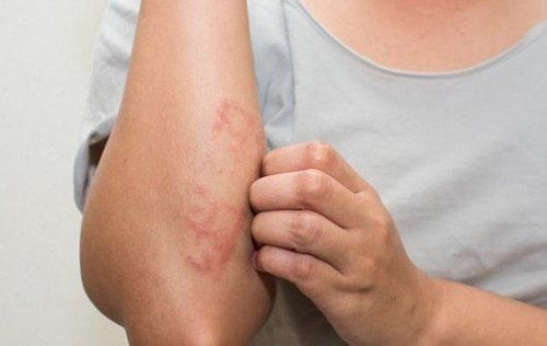 Chàm bàn tay là loại bệnh chàm chỉ ảnh hưởng đến tay.