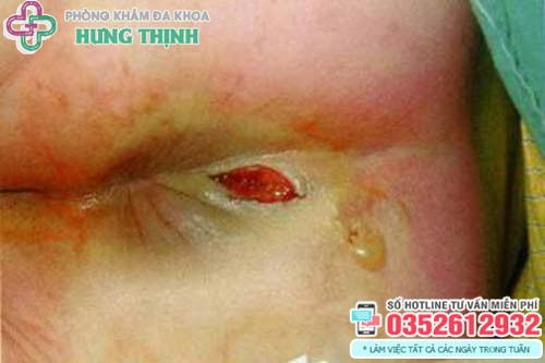 Hình ảnh rò hậu môn ở trẻ sơ sinh