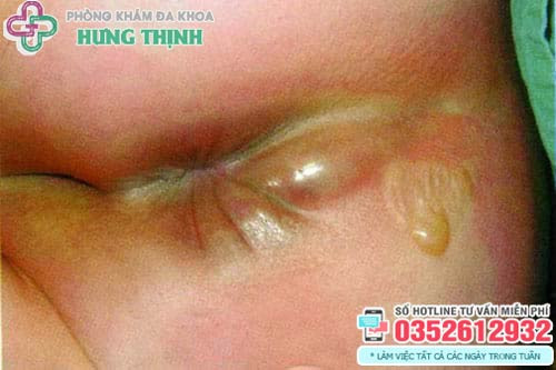 Chẩn đoán hình ảnh rò hậu môn