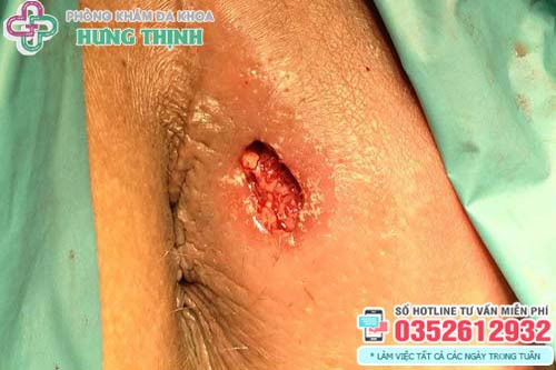 Hình ảnh bệnh rò hậu môn