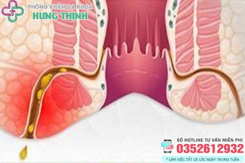 Triệu chứng bệnh rò hậu môn