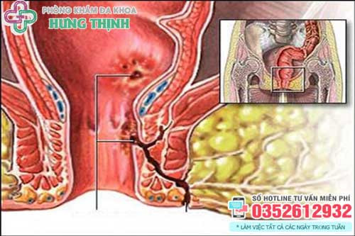 Bệnh rò hậu môn có nguy hiểm không?