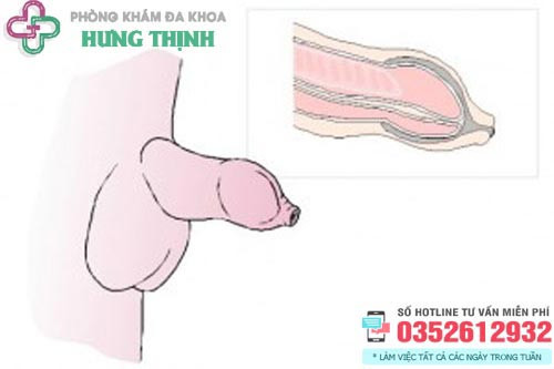 Hình ảnh hẹp bao quy đầu tổng quan