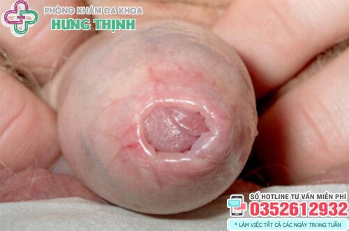 Trẻ nhỏ với tình trạng hẹp bao quy đầu cần được theo dõi