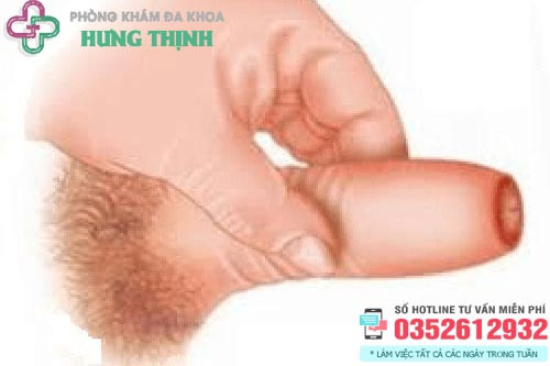 Hẹp bao quy đầu ở người trưởng thành gây khó chịu
