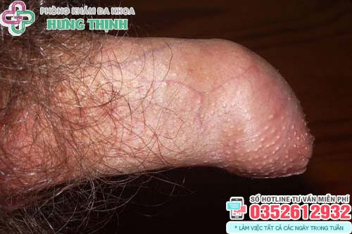 Biểu hiện hẹp bao quy đầu ở nam giới trưởng thành