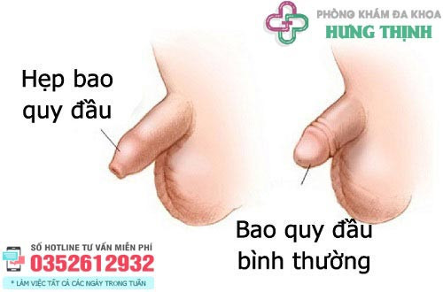 So sánh hẹp bao quy đầu và bao quy đầu bình thường