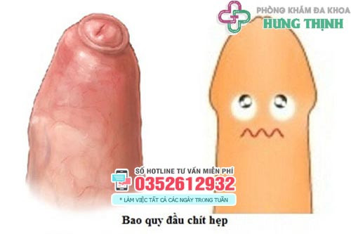 Hình ảnh chít hẹp bao quy đầu ở trẻ nhỏ