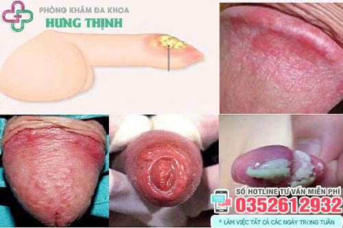 Hậu quả của hẹp bao quy đầu nếu không được điều trị