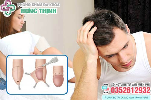 Các phương pháp xử lý hẹp bao quy đầu