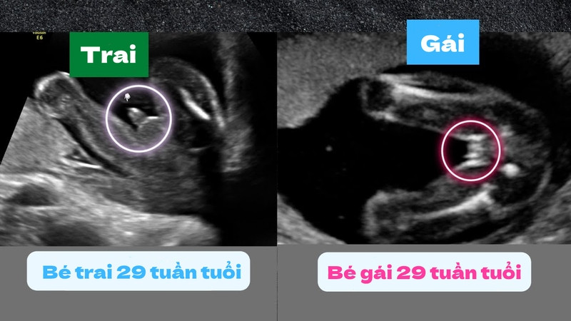 Nhìn hình siêu âm làm sao biết trai hay gái bạn cần quan sát vị trí giữa háng