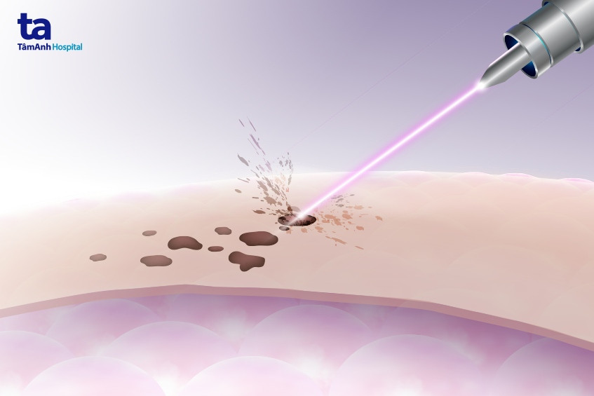 Ánh sáng từ tia laser loại bỏ sắc tố gây thâm sạm và tế bào da cũ