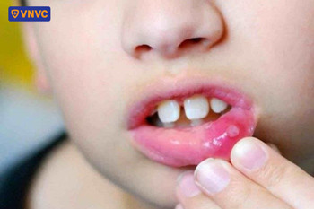 Dấu hiệu nhận biết nhiệt miệng đơn lẻ hoặc vài vết loét nhỏ