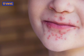 Dấu hiệu nhận biết tay chân miệng với nhiều mụn nước và vết loét