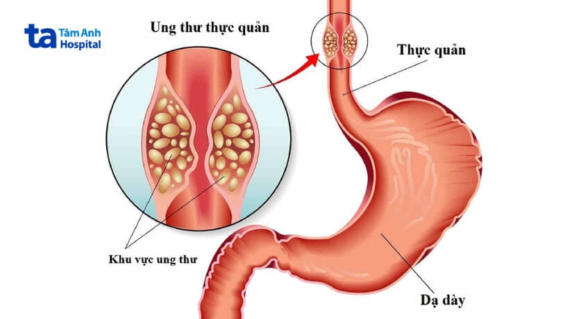Mô hình giải phẫu thực quản bị ung thư