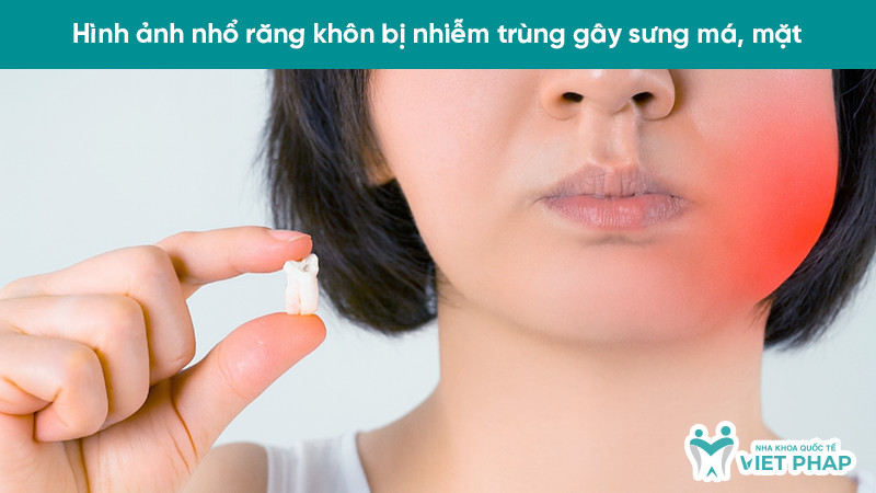 Má sưng tấy rõ rệt do nhiễm trùng sau nhổ răng khôn