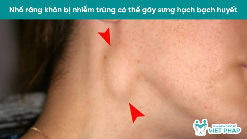 Hạch bạch huyết dưới hàm hoặc cổ sưng to do nhiễm trùng